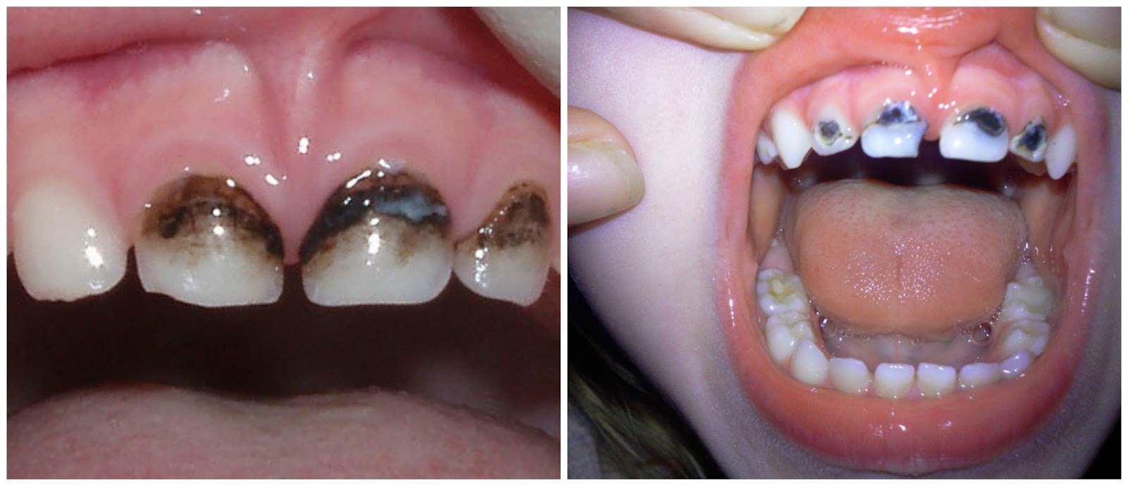 Фото: После лечения зубов серебрением у детей темнеют зубы