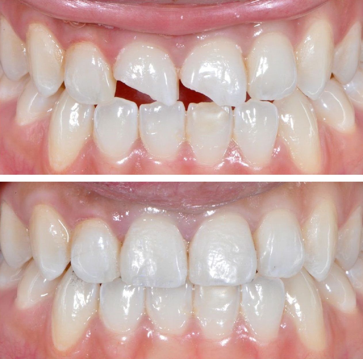 Фото: возможности художественной реставрации зубов позволяют скрыть даже сильные дефекты
