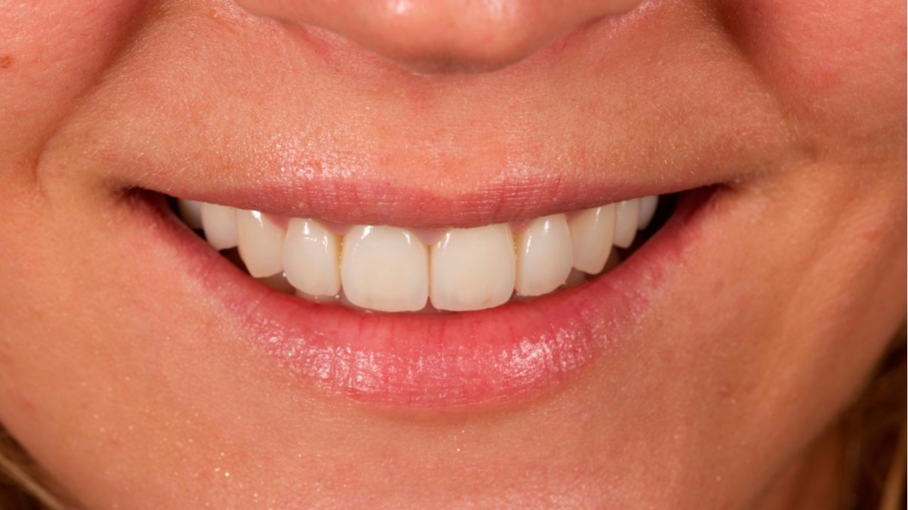 Фото: Линия улыбки после реставрации передних зубов идеальная