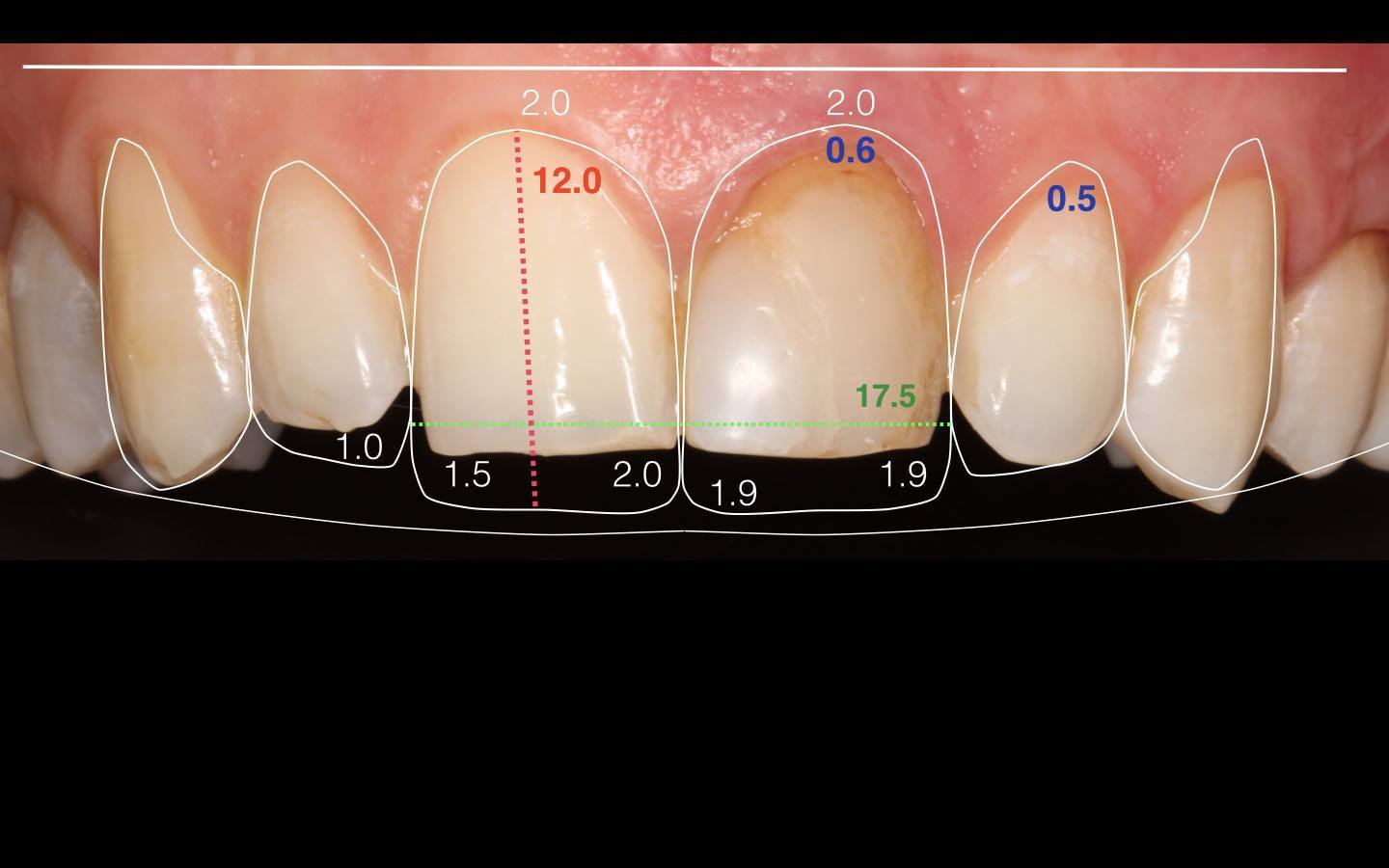Фото: компьютерное моделирование челюсти в эстетической стоматологии помогает показать пациенту, как будет выглядеть зубной ряд