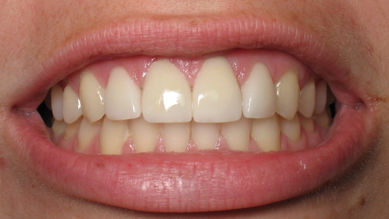 Фото: улыбка становится красивой с имплантами на передних зубах
