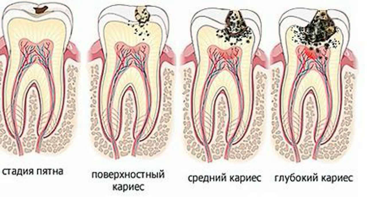 Фото: Перед лечением кариеса у детей стоматолог определяет степень разрушения зуба