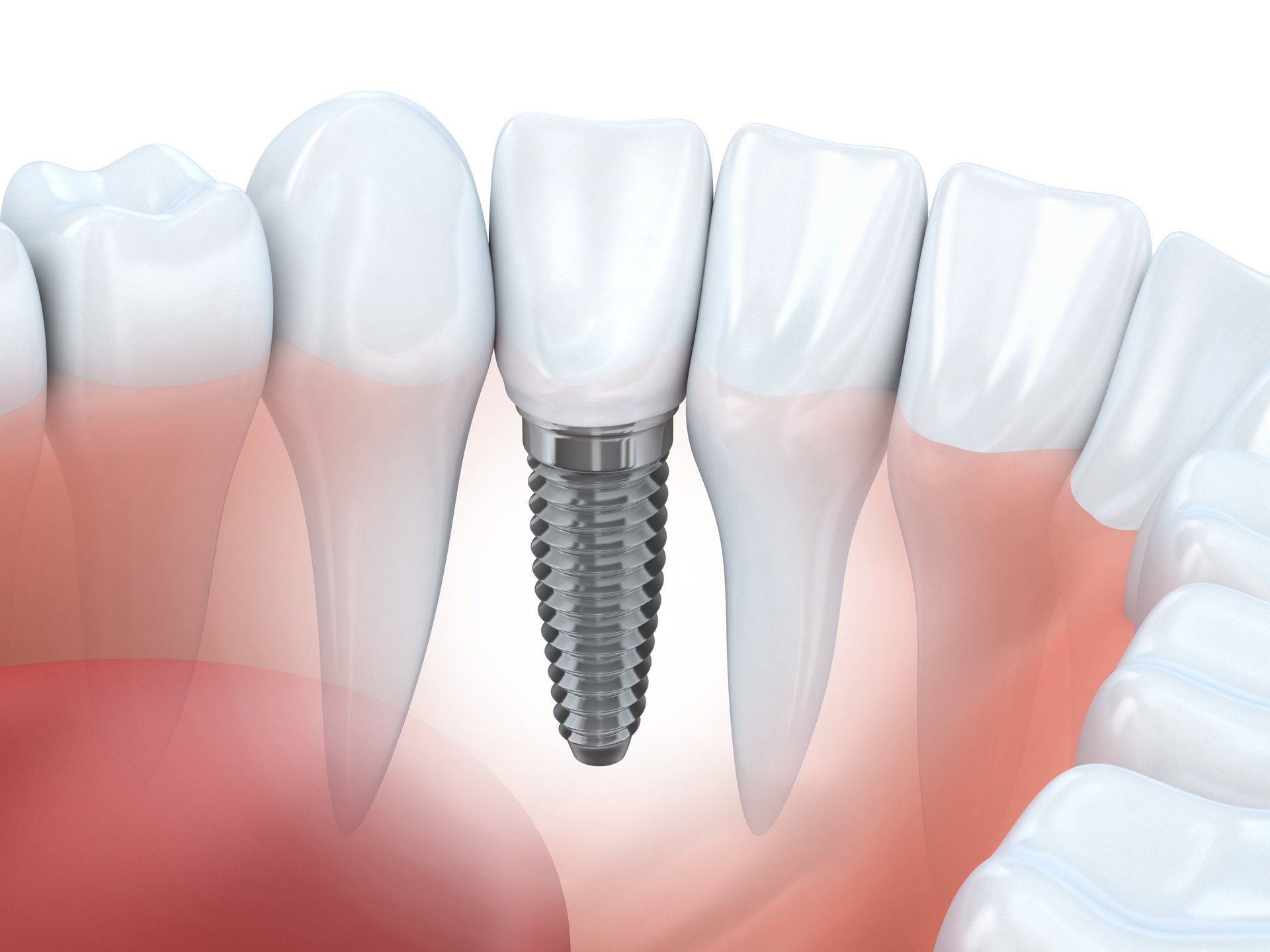Фото: при дентальной имплантации не требуется стачивать рядом стоящие родные зубы