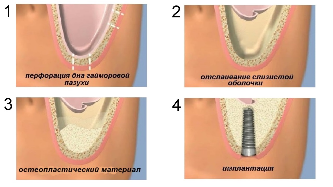Фото: синус-лифтинг в современной стоматологии позволяет нарастить кость перед имплантацией верхней челюсти