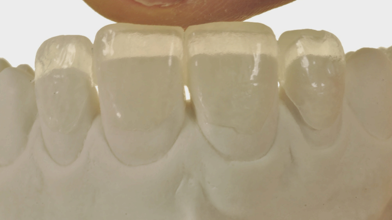 Фото: виниры на передние зубы из керамики делают двумя способами