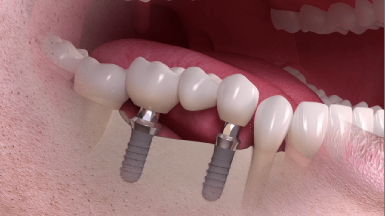 Фото: установка мостовидного протеза в дентальной имплантации не требует вживления имплантов для каждого зуба