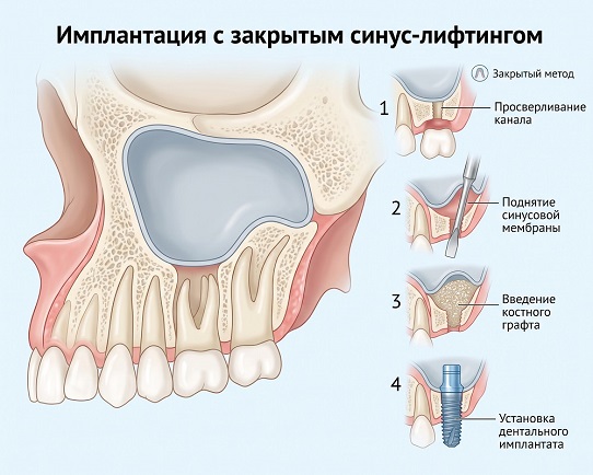 Имплантация с закрытым синус-лифтингом зубов в Челябинске