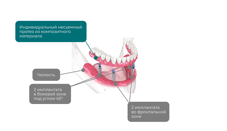 СХЕМА ИМПЛАНТАЦИИ-all-on-4