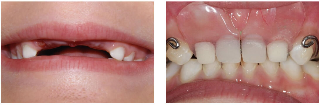 Фото: При хорошем лечении молочных зубов ставят временный протез для формирования правильного прикуса, если удалено несколько штук