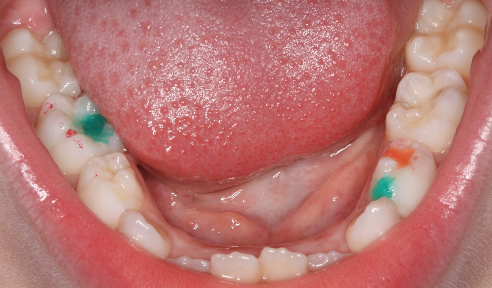 Фото: При лечении молочных зубов у детей можно ставить цветные пломбы