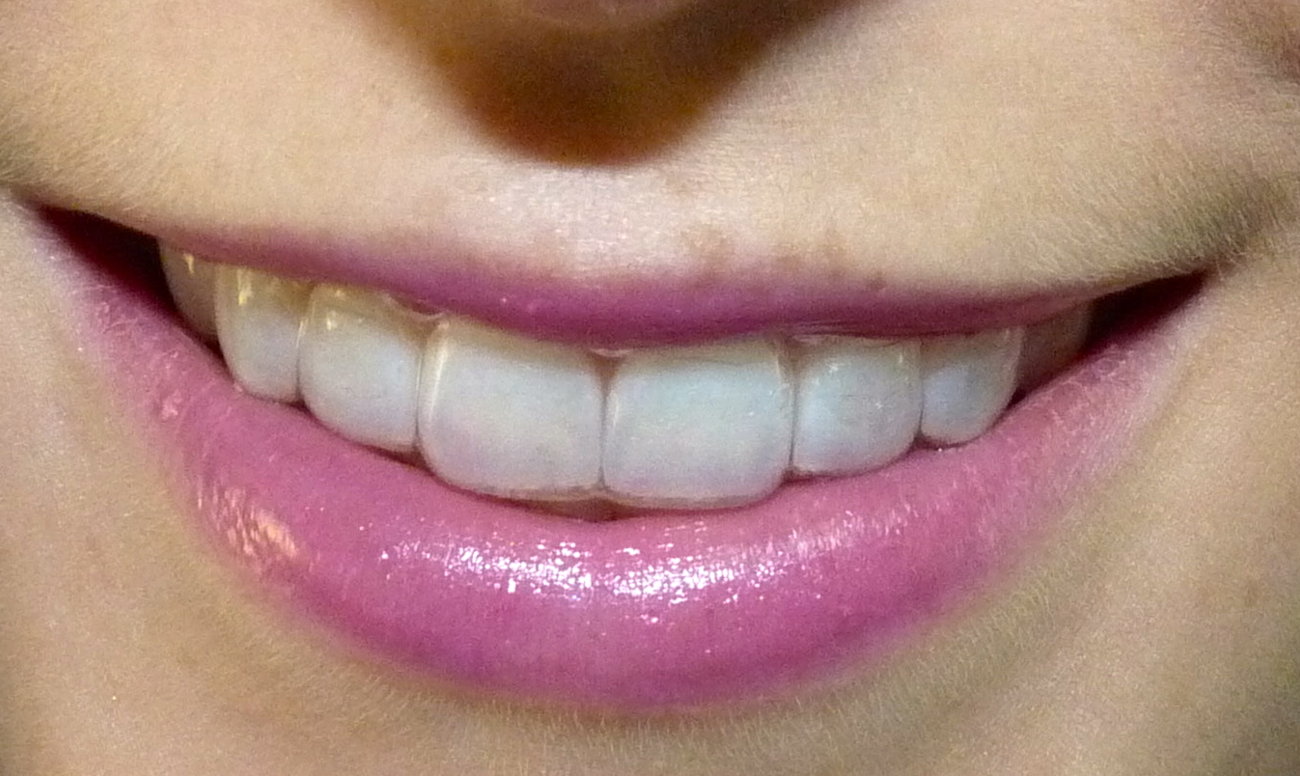 Фото: элайнеры в эстетической стоматологии используют как альтернативу брекетам