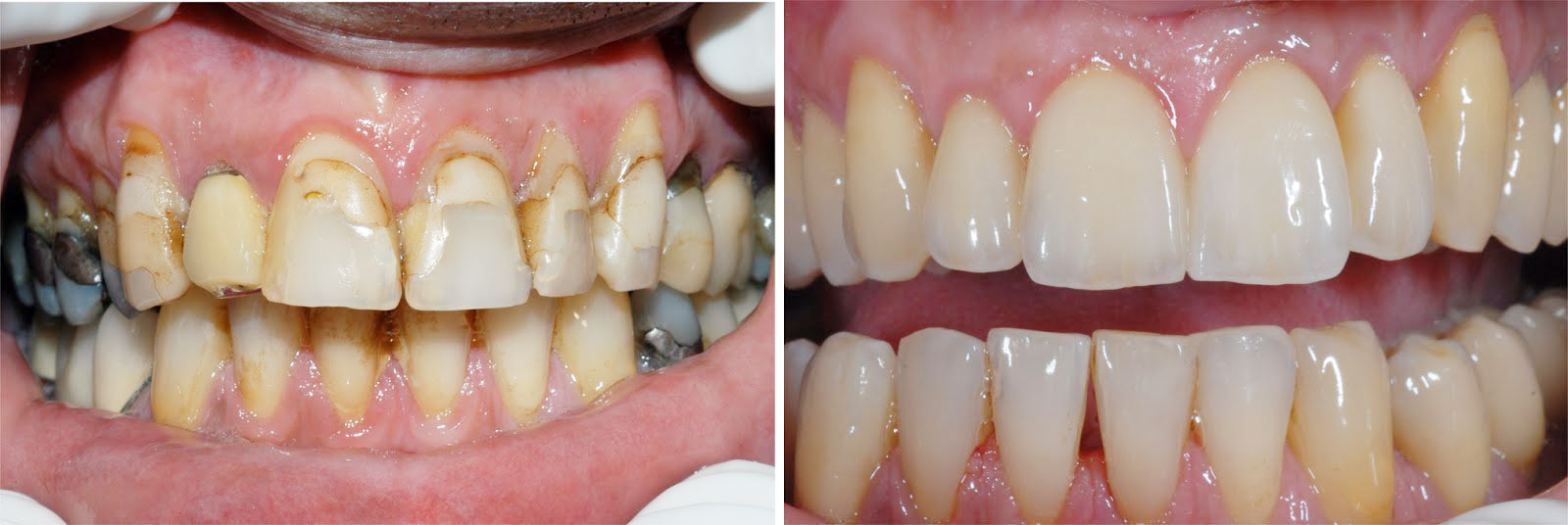 Фото: в эстетической стоматологии коронками исправляют сильно поврежденные или разрушенные зубы