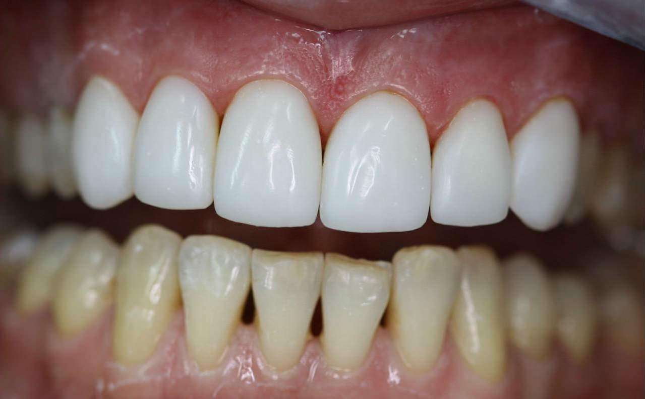 Фото: люминиры на верхней и нижней челюсти в эстетической стоматологии устанавливают без обтачивания зубов