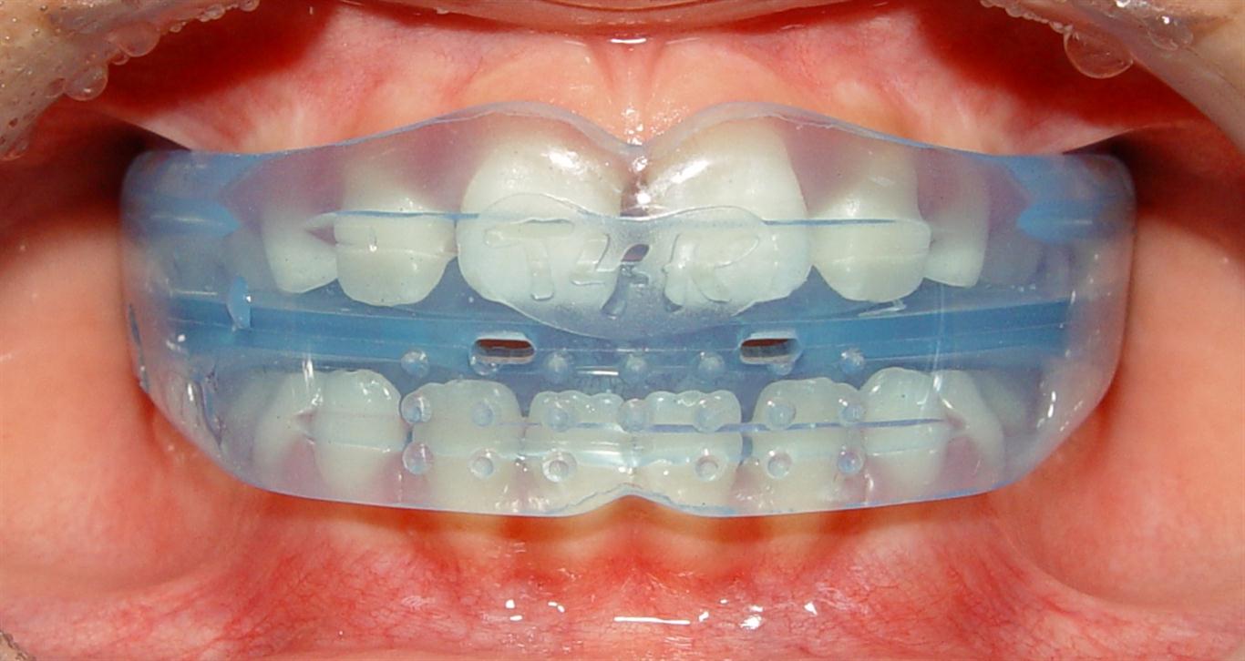Фото: в эстетической стоматологии трейнеры используют для выравнивания зубов у детей
