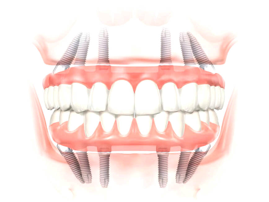 Фото: имплантацию зубов челюсти делают на шести имплантах при атрофии кости