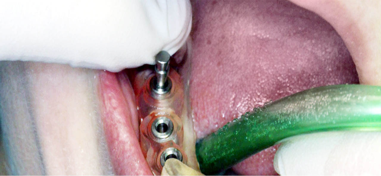 Фото: имплантация зубов челюсти с использованием хирургического шаблона