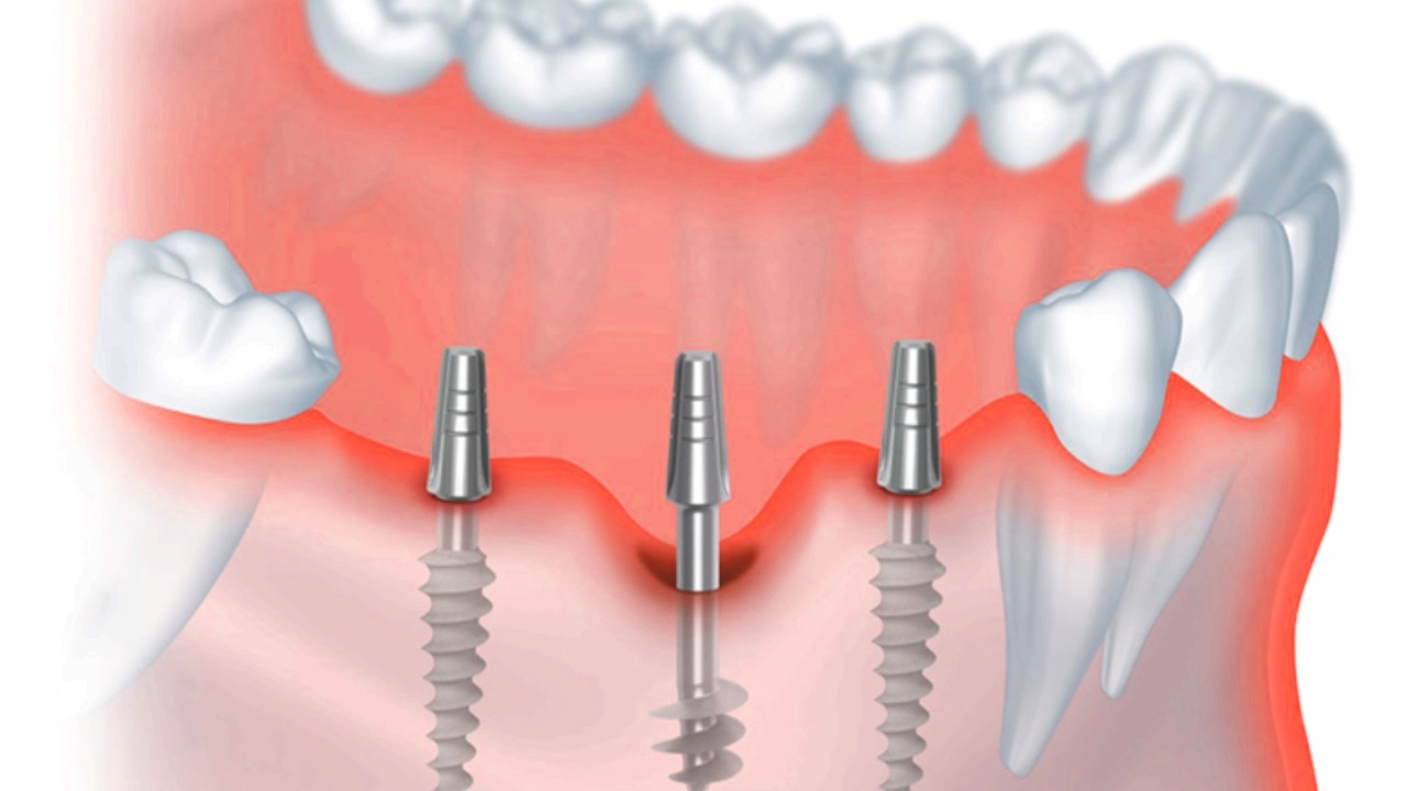 Фото: импланты для базальной имплантации зубов челюсти производят цельными