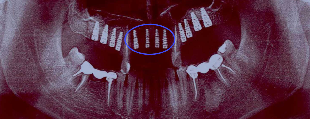 Фото: импланты на передних зубах тоньше жевательных, потому что на них нет сильной нагрузки