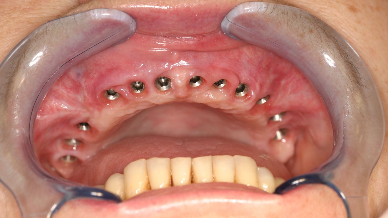 Фото: классическая имплантация зубов челюсти требует установки одного импланта для восстановления одного зуба
