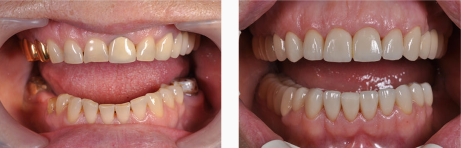 Фото: металлокерамические коронки улучшают вид зубов, исправляя недостатки
