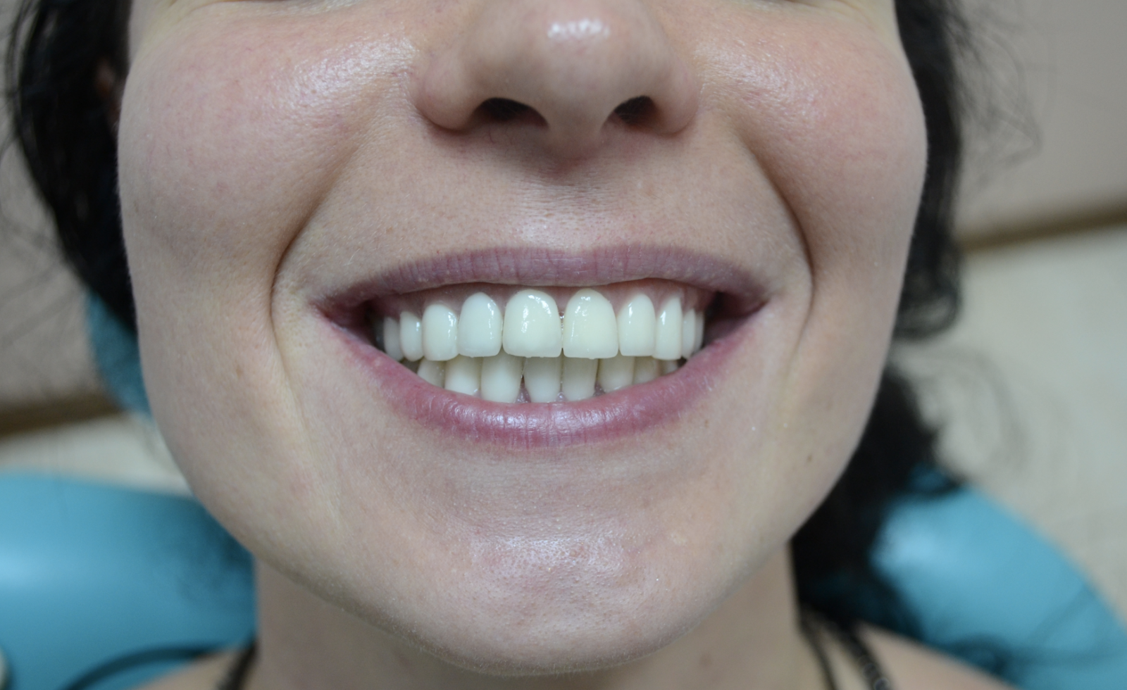 Фото: металлокерамические зубы выглядят неестественно, потому что на них нет блеска и прозрачности, как на эмали