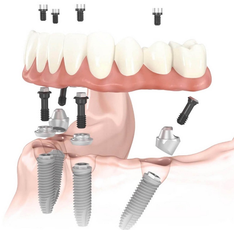 По технологии all-on-4 может быть достаточно 4 имплантов, чтобы восстановить зубы на всей челюсти всего за 8-12 часов
