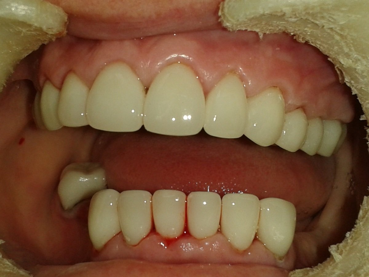 Ношение съемных протезов часто травмирует соседние зубы и десна, а из-за неправильной и недостаточной нагрузки  приводит к атрофированию костной ткани