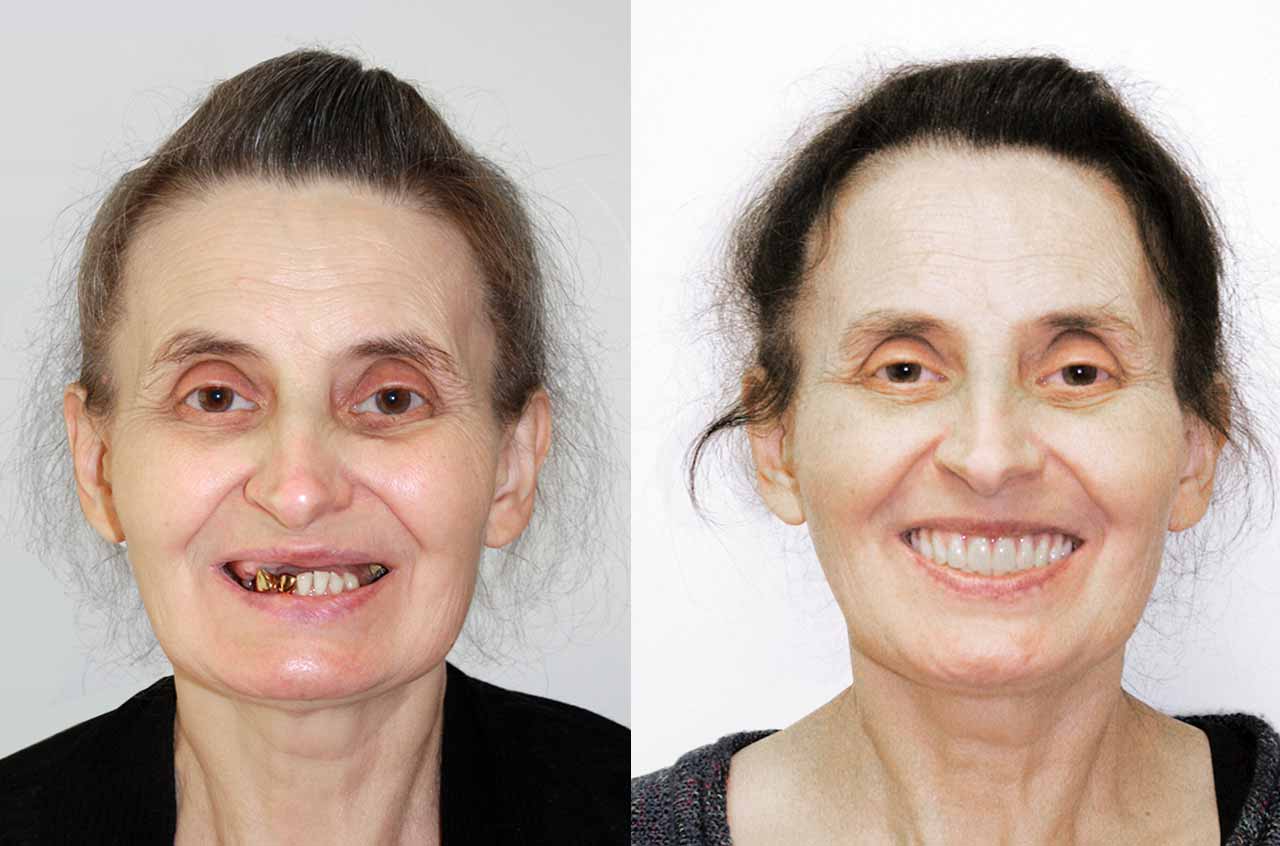 Зубы импланты до и после
