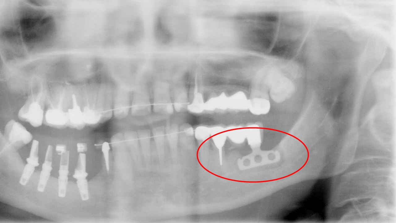 Фото: пластиночный имплант жевательных зубов устанавливают при невозможности нарастить костную ткань