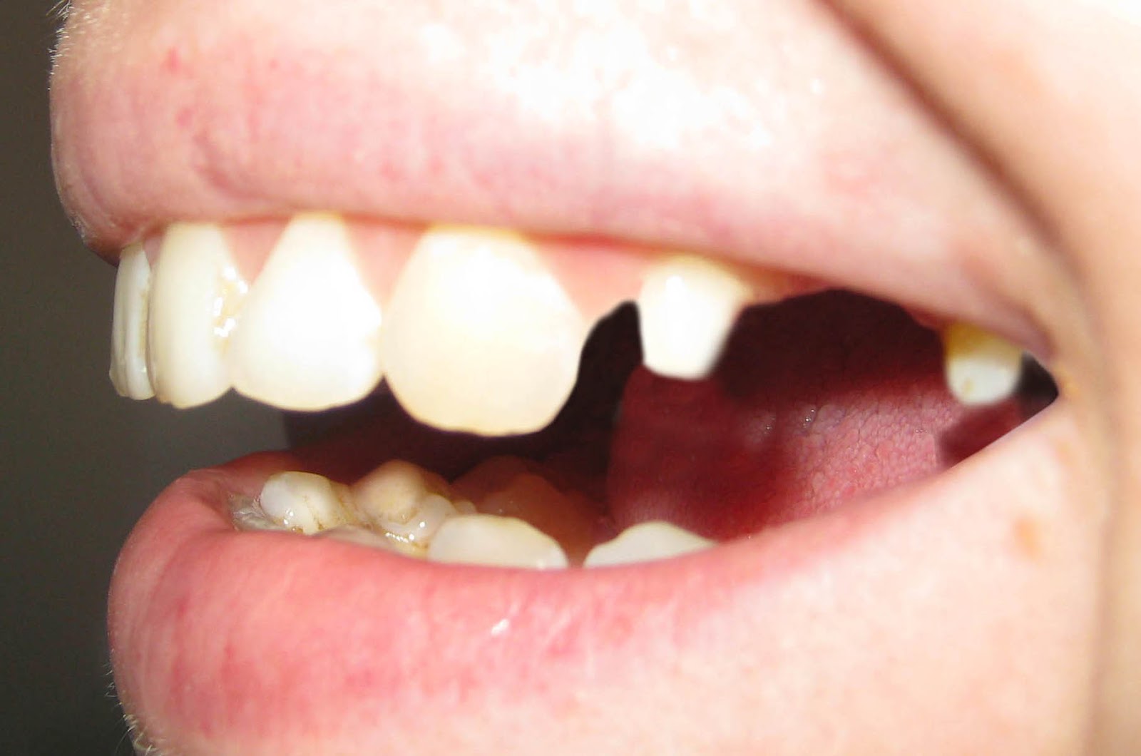 Фото: для установки металлокерамических коронок стачивают зубы