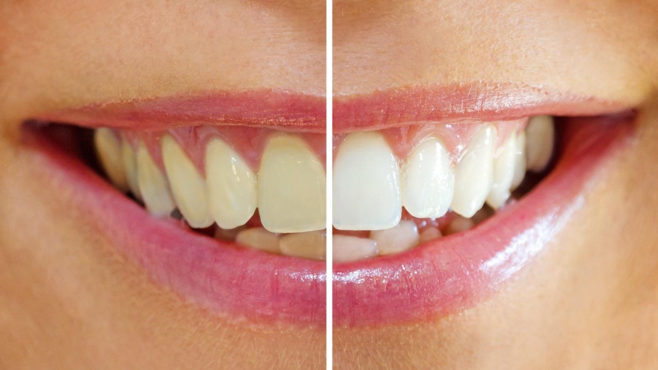 Фото: результат отбеливания в эстетической стоматологии заметен сразу после процедуры