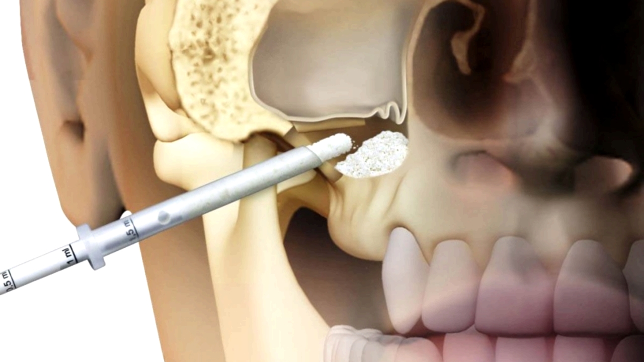 Фото: синус-лифтинг делают перед имплантацией зубов на верхней челюсти, если не хватает кости