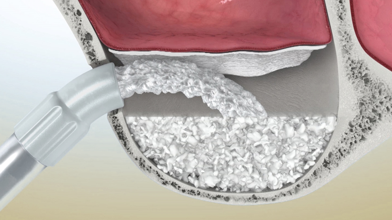 Фото: синус-лифтинг обязателен перед установкой импланта на передние зубы, если кость рассосалась без нагрузки