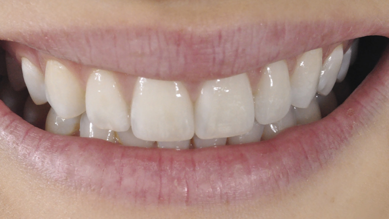 Фото: чтобы поставить коронку на зуб из керамики, не нужно его сильно стачивать