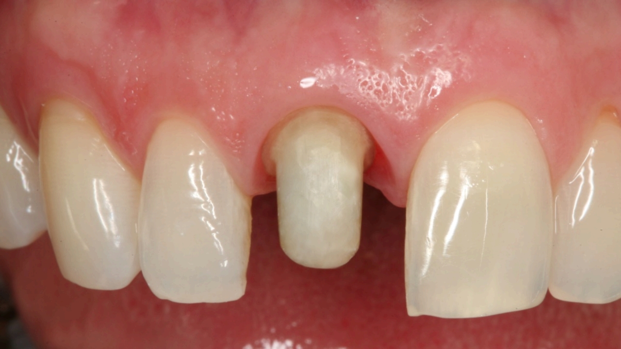 Фото: чтобы поставить коронку на зуб из металлокерамики, нужно сильно его сточить