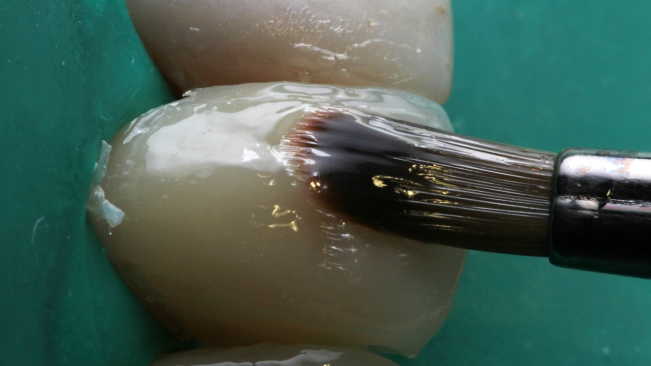    Фото: сколько стоит реставрация зуба: бондинг — самая дешевая и менее качественная процедура