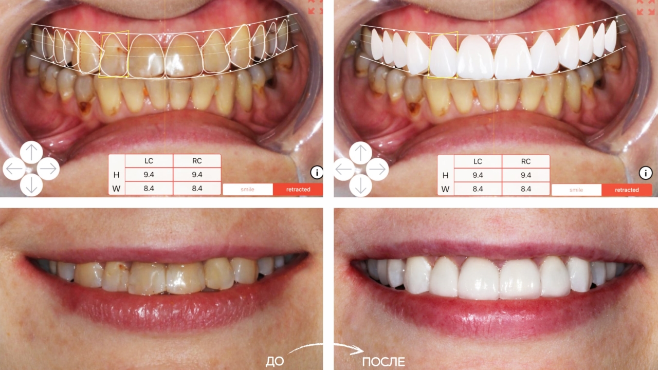 Фото: сколько стоит реставрация зуба с помощью аппарата Cerec, зависит от сложности изделия