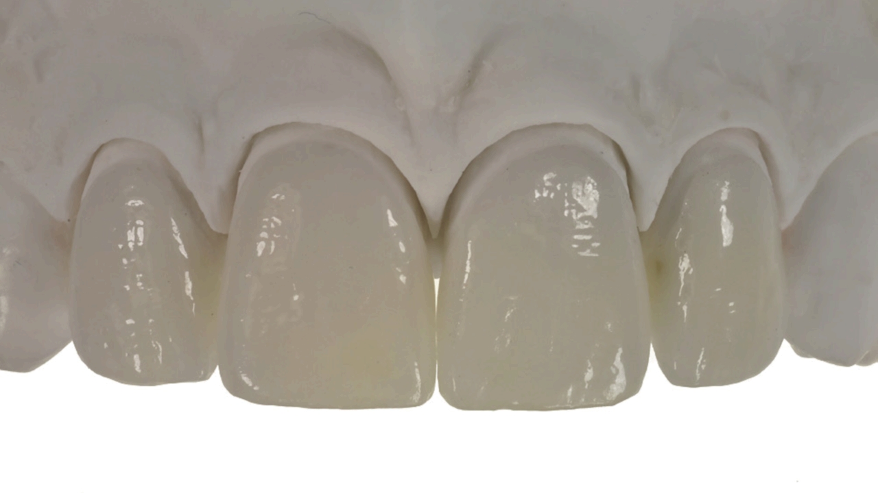Фото: сколько стоит реставрация зуба керамикой, зависит от способа изготовления конструкции