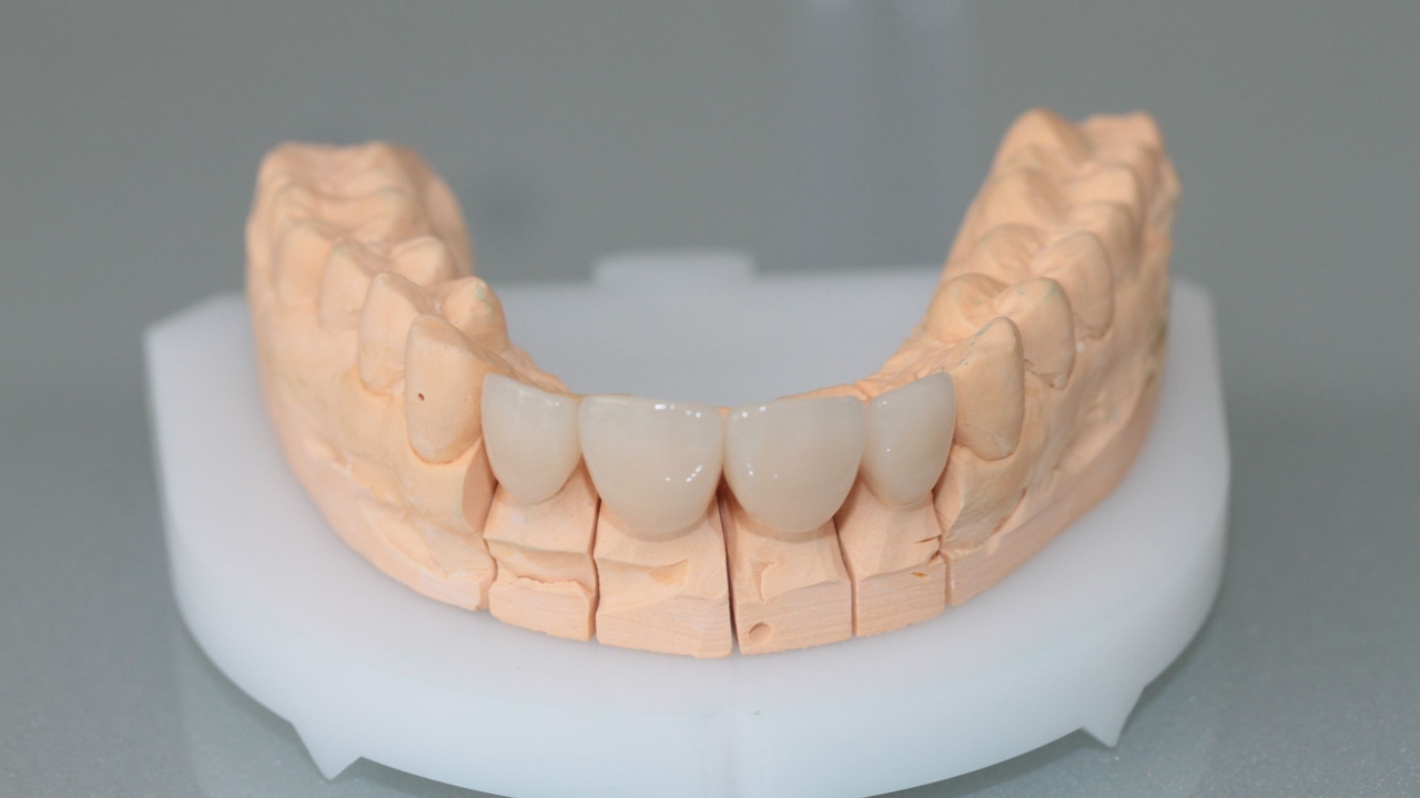 Особенности художественной реставрации зубов, влияющие на стоимость