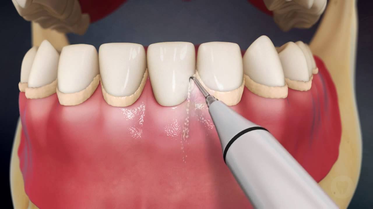 Фото: ультразвуковую чистку зубов в эстетической стоматологии делают специальным стержнем