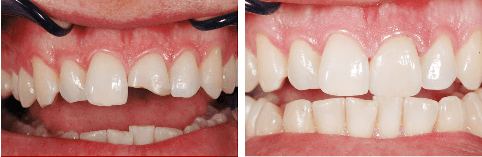 Фото: устаревшую процедуру эстетической стоматологии бондинг уже почти не делают
