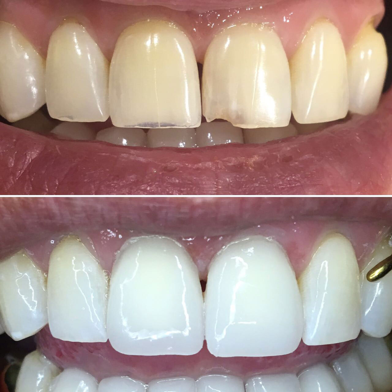 Фото: в эстетической стоматологии виниры исправляют значительные дефекты зубов
