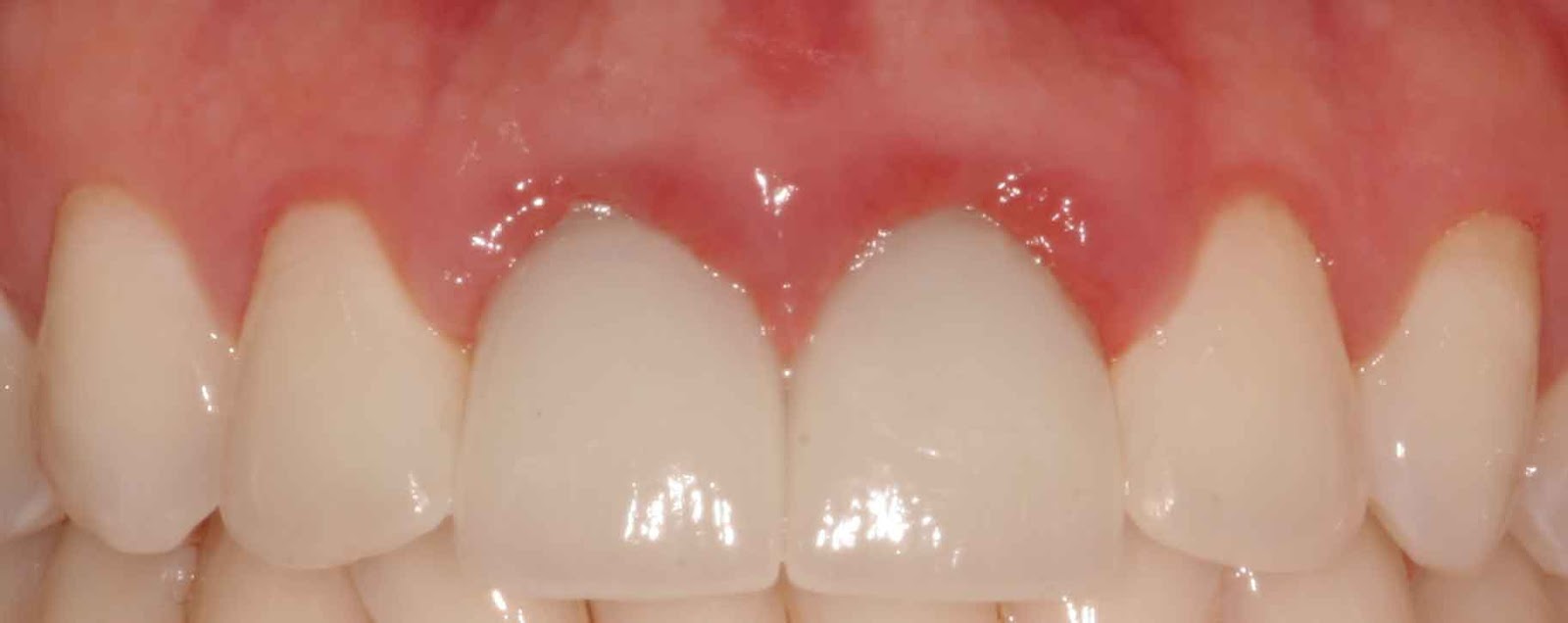Фото: воспаление десны возле металлокерамических зубов происходит из-за попадания цемента в десневые карманы