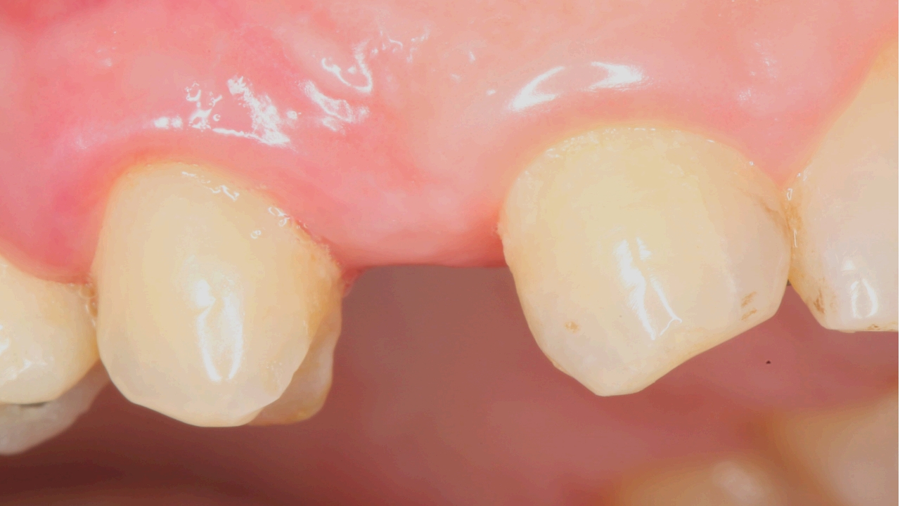 Фото: вшитый имплант жевательного зуба при классическом протезировании