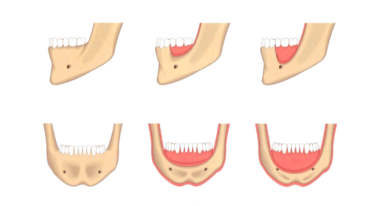 Фото: убыль кости происходит, если не делать имплантацию зубов челюсти